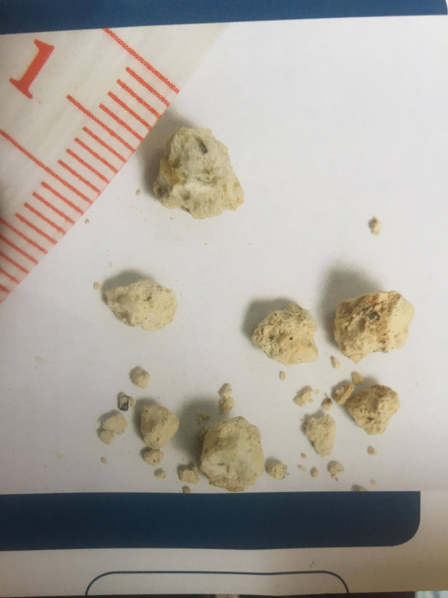 Ăn mặn, ít uống nước là đang ‘nuôi’ sỏi niệu