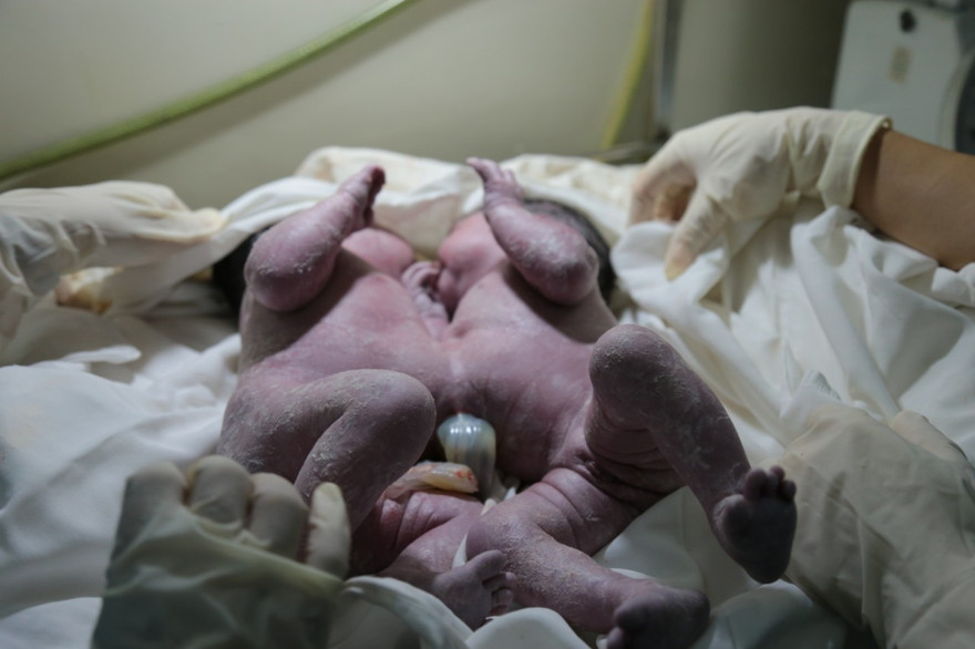 Phẫu thuật thành công ca sinh đôi dính chặt gan