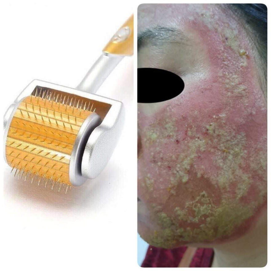 Mất 40 triệu đồng lăn kim làm đẹp, người phụ nữ rước hoạ vì mặt thành ổ mủ