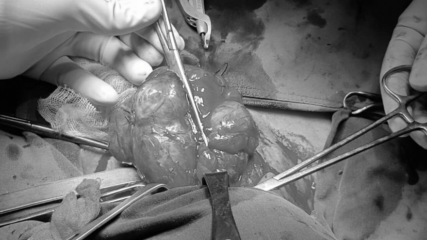 Cụ bà 74 tuổi mang khối bướu cổ gần 50 năm