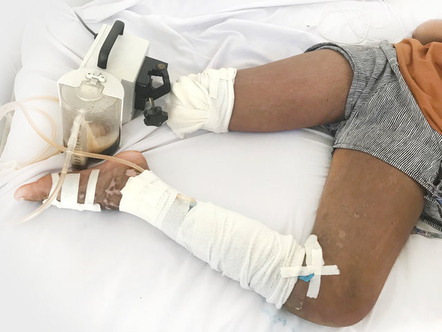 Bé gái 13 tuổi phải cắt bỏ chân vì nhờ thày lang vườn trị rắn cắn