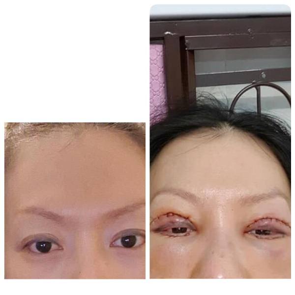 Thẩm mỹ ở cơ sở 'dỏm', đau đớn vì mắt không thể nhắm kín