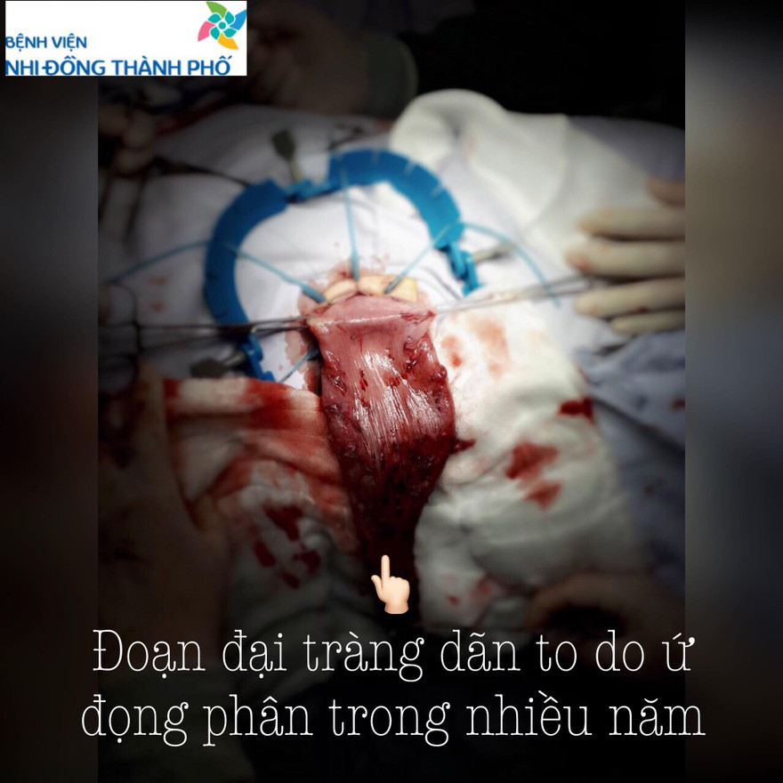 Bé trai 5 tuổi bụng phình to như bà bầu vì táo bón