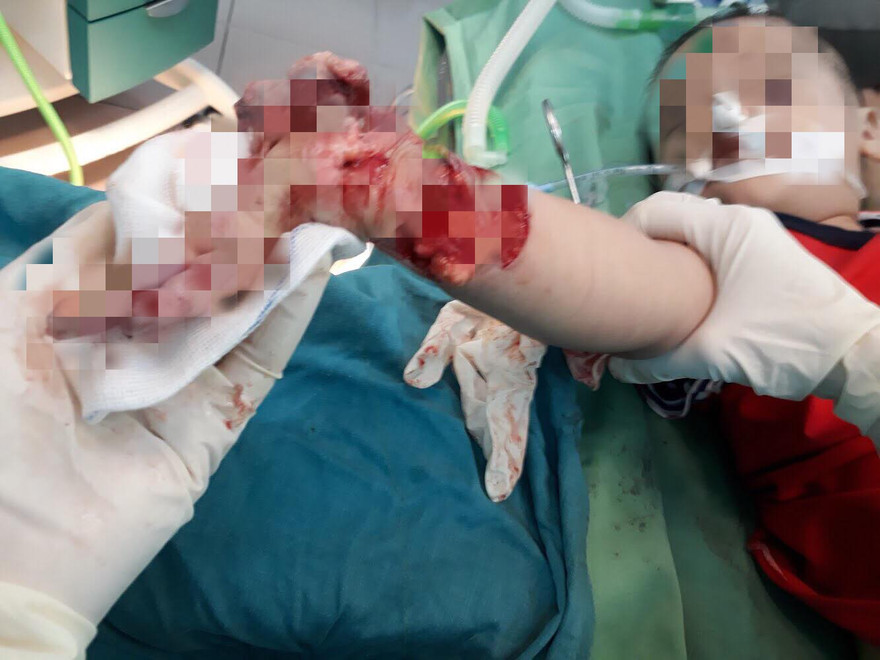 Người lớn lơ là, bé trai 3 tuổi bị máy xay thịt nghiền nát cánh tay