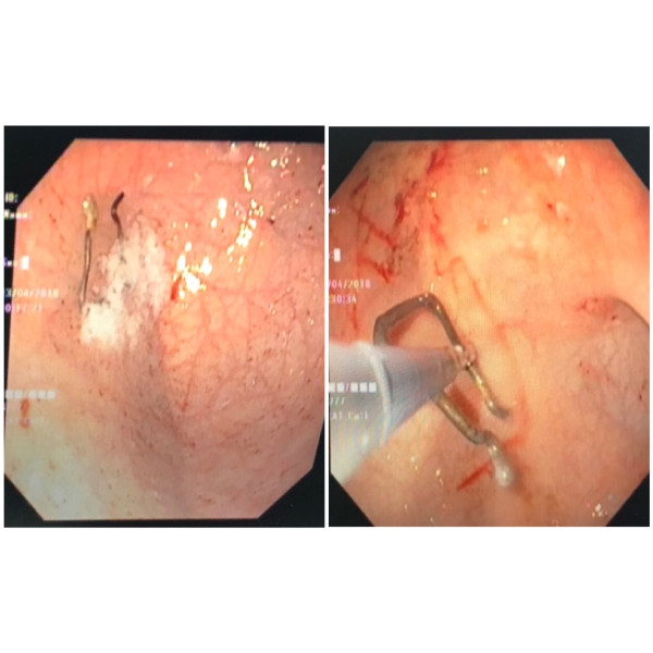 Nuốt móc sắt kẹp quần áo, bé trai 18 tháng suýt thủng ruột