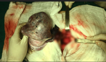 Bé gái 13 tuổi ngỡ mang bầu 6 tháng vì khối u buồng trứng khổng lồ