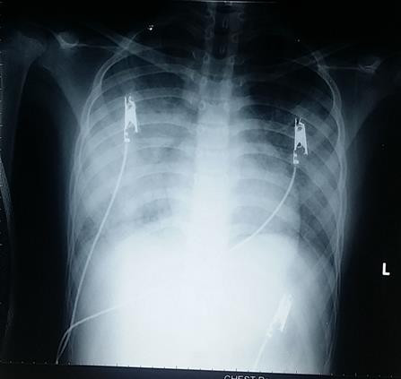 Bé gái mắc bệnh hiếm : 1 triệu người mới có người mắc