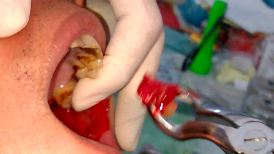 Hậu nhổ răng,... bàng hoàng biết bị nhiễm trùng van tim