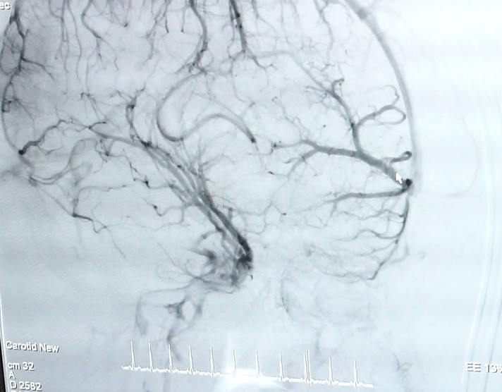 Nôn ói cứ ngỡ trúng thực, bệnh nhân suýt chết vì xuất huyết não