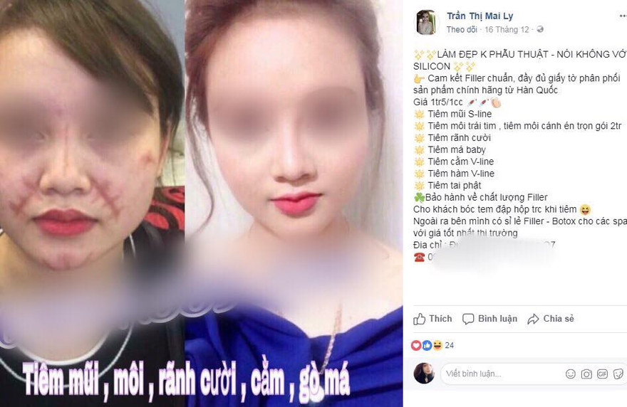 Tiêm filler: Sau công dụng 'thần tiên', làm nhanh giá rẻ là ẩn họa khôn lường!