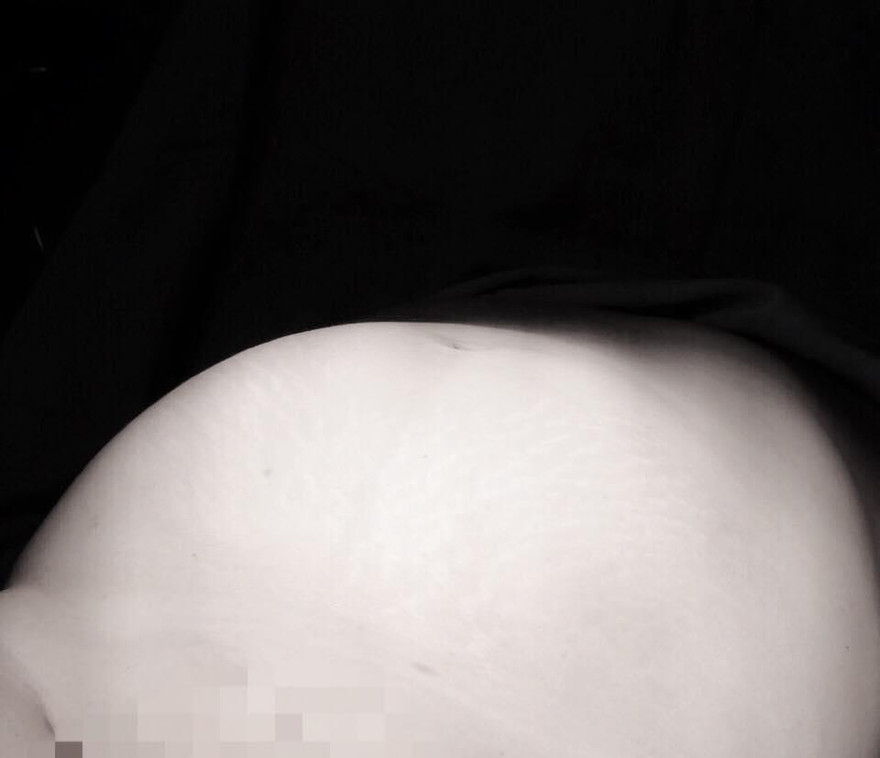 Nữ bệnh nhân mang khối u khủng nặng 8kg 