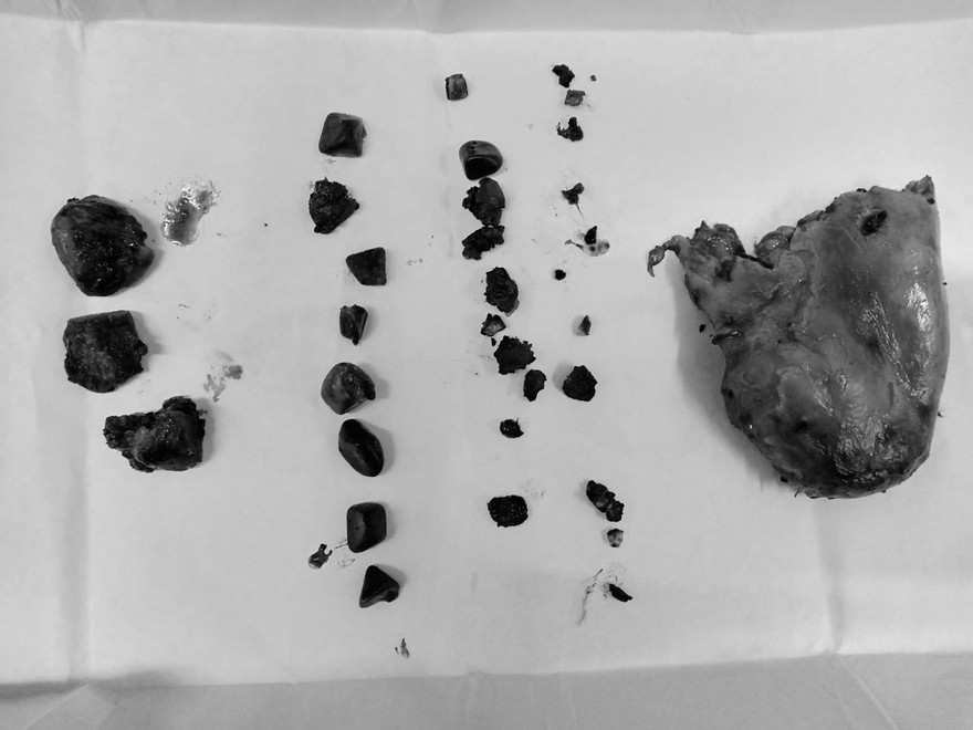 Người đàn ông có túi mật chứa tới gần 50 viên sỏi