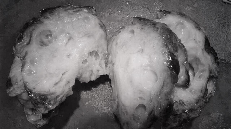 Bé trai có khối bướu to như quả bưởi trên mặt