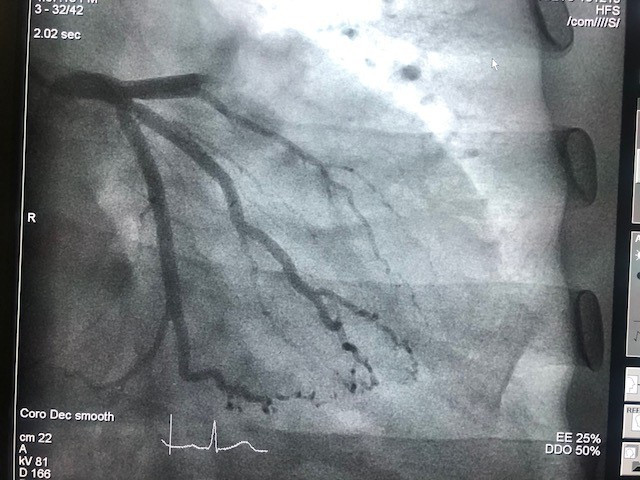 Cụ ông 91 tuổi suýt chết vì nhồi máu cơ tim do gia đình nhầm say rượu