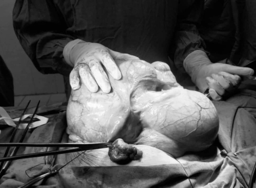 Người phụ nữ mang khối u hơn 6kg trong bụng nhưng không hay biết