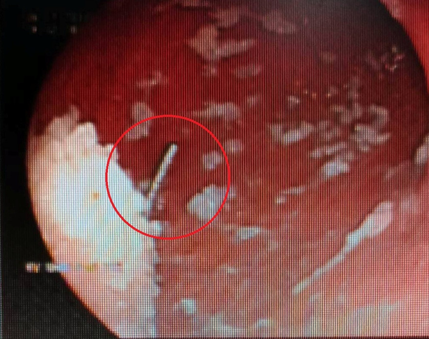 Đùa giỡn với bạn, nam thanh niên nuốt cả kim may vào bụng