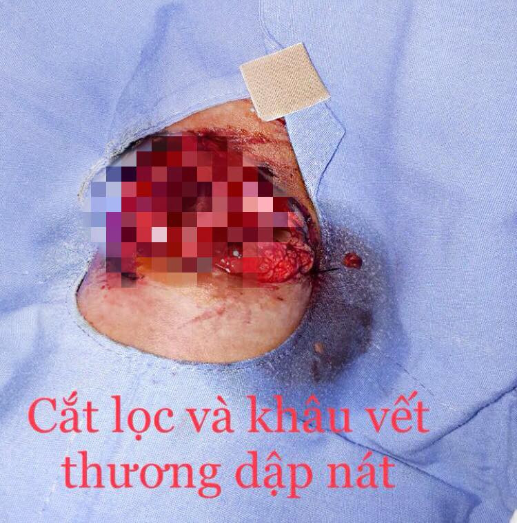 Bé gái 13 tuổi gần đứt lìa tay vì pháo nổ văng trúng