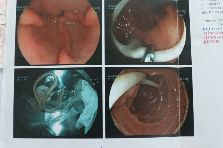Ngỡ viêm dạ dày, ai ngờ 2 con sán 'làm tổ' trong tá tràng