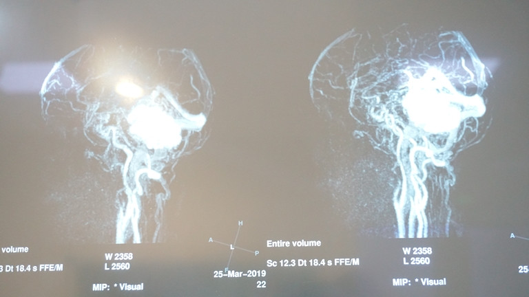 15 giờ căng thẳng cứu sống bệnh nhân u não nhiều nơi từ chối điều trị