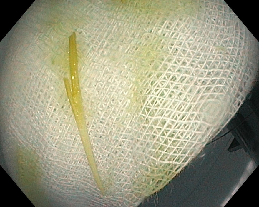 Que tăm đâm thủng tá tràng người phụ nữ