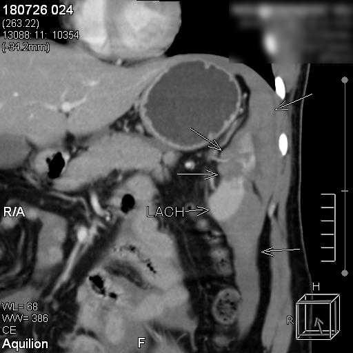 Suýt chết vì vỡ lách sau tai nạn giao thông dù không chảy máu