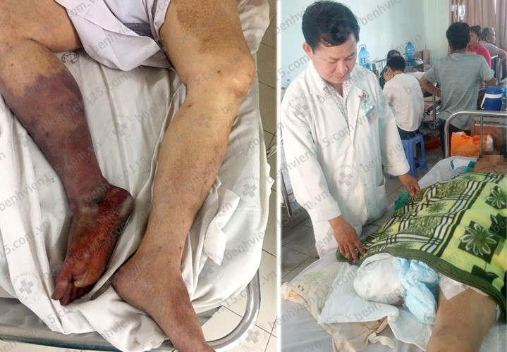 Cắt bỏ chân vì hoại tử do uống thuốc tim mạch không đều