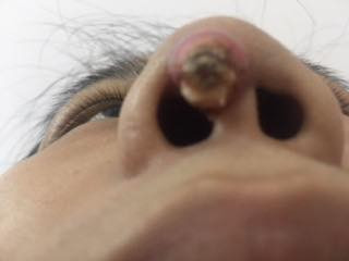 Nâng mũi tại tiệm cắt tóc, người phụ nữ lòi cả đầu sống mũi ra ngoài