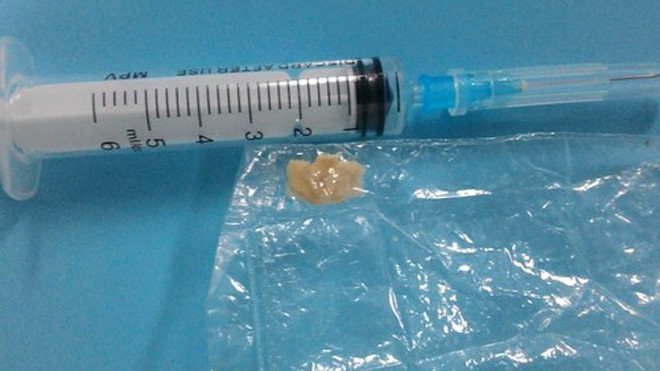 Miếng mít non được gắp ra từ phế quản của trẻ. 