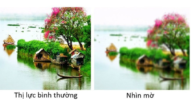 Đừng bỏ qua tình trạng nhìn mờ dù tình trạng này xảy ra thoáng qua hay thường xuyên.