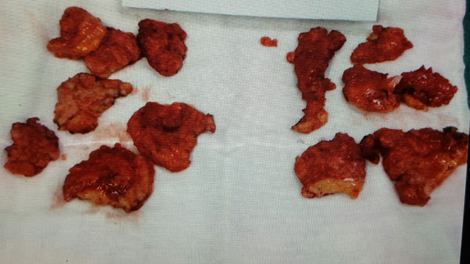 Silicon được quảng cáo là “mỡ nhân tạo” bơm vào ngực chị H.