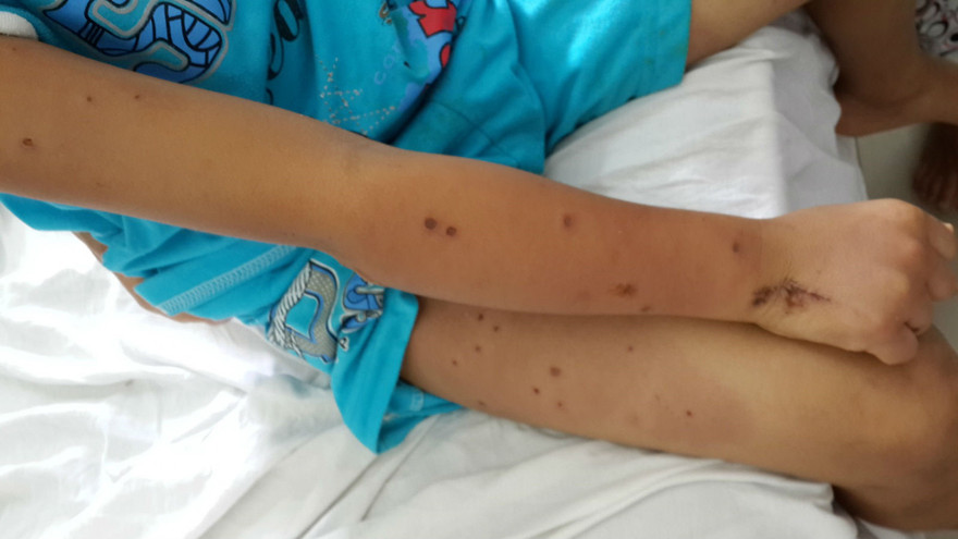 Các vết đốt của ong. 