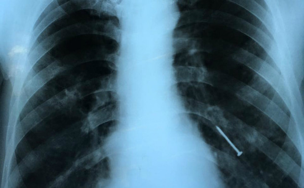 Hình ảnh X-quang cây đinh nằm ở phế quản bệnh nhân. Ảnh: V.T.