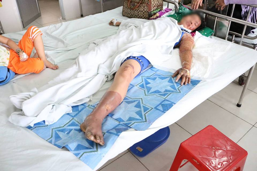 Chị M. bị bỏng 60% cơ thể đang được điều trị tại bệnh viện.