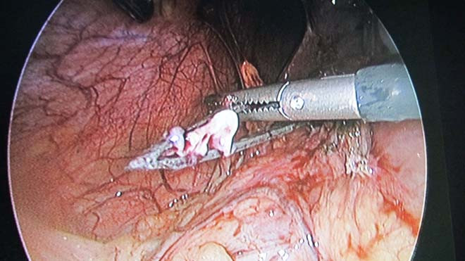 Đây là ca phẫu thuật khó, dị vật nằm lâu trong bụng khiến tá tràng viêm dính nhiều sát vào thành bụng. 