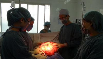 Khối u nặng trên 10 kg được xử lý thành công. *ảnh: BV cung cấp