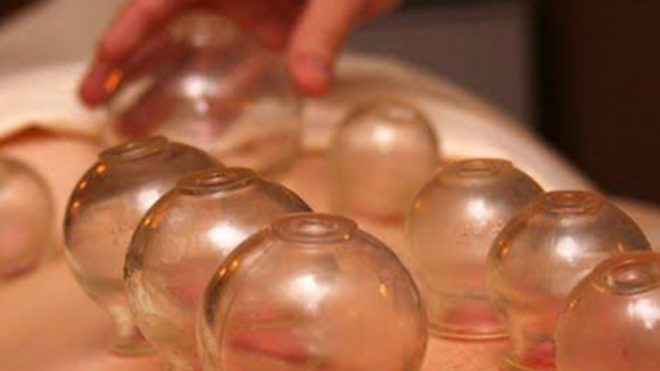 Giác hơi là liệu pháp chữa trị có lịch sử lâu đời trong y học cổ truyền Trung Quốc. Ảnh minh họa: Silk Spa