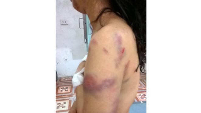 Những vết thương trên cơ thể cô Oanh được cho là do chồng cũ đánh. Ảnh: Facebook.