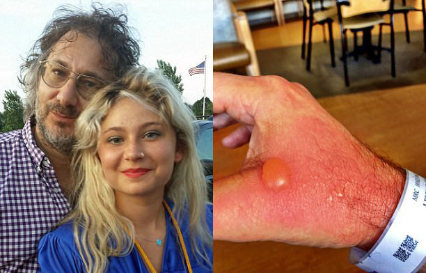 Bỏng độ 2 vì vắt nước cốt chanh dưới nắng