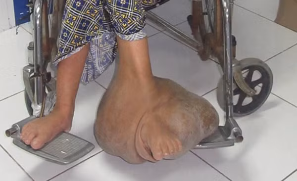 Sau 6 giờ phẫu thuật, ê kíp đã lấy được khối u nặng gần 10kg.