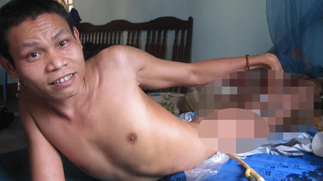 Đôi chân của anh Bách được nối bằng nhiều ốc vít. 