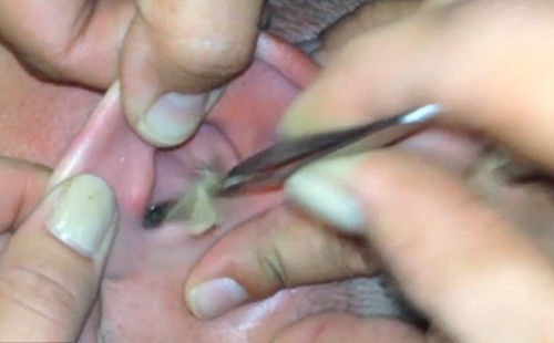 Con sâu bướm còn sống được lấy ra từ tai Mikey. Ảnh: Newsrt.