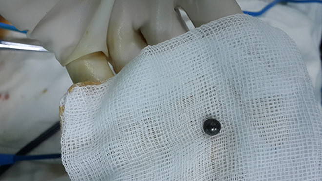 Viên bi xe đạp đã được lấy ra Ảnh: Bệnh viện Nhân dân 115 cung cấp