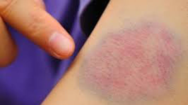 Bệnh nhận bị rối loạn đông máu thường xuất huyết các vệt bầm tím. Ảnh: Sức khỏe đời sống.