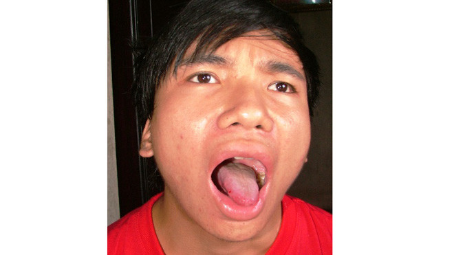 Mỗi khi lên cơn đau, nấm nem ở lưỡi em cứ lại xuất hiện cộng thêm nước bọt tiết ra nhiều khiến miệng bị sưng lên rất đau đớn.