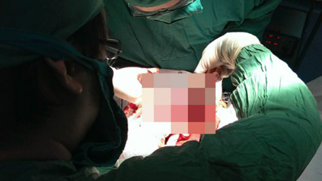 Hẹp da quy đầu là nguyên nhân hàng đầu gây ung thư dương vật. Ảnh: N.K.B.D