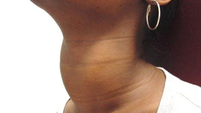 Những khối u cảnh báo bệnh lý nguy hiểm