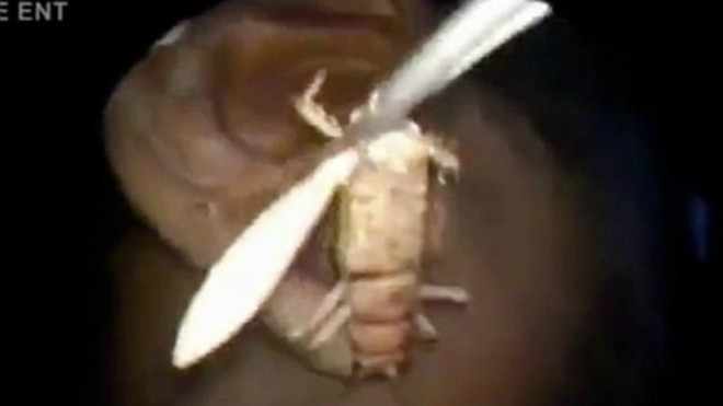 Con dế còn sống dài gần 8 cm được thận trọng lôi ra khỏi tai bệnh nhân. Ảnh: Newsrt.