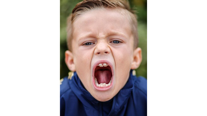 Cậu bé Zak Brown sở hữu đến 4 hàm răng 