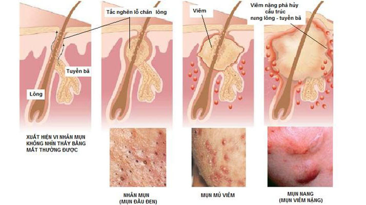 Cơ chế của mụn trứng cá.