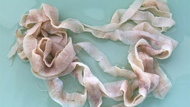 Cá thể sán dây dài 12m được phát hiện bên trong cơ thể